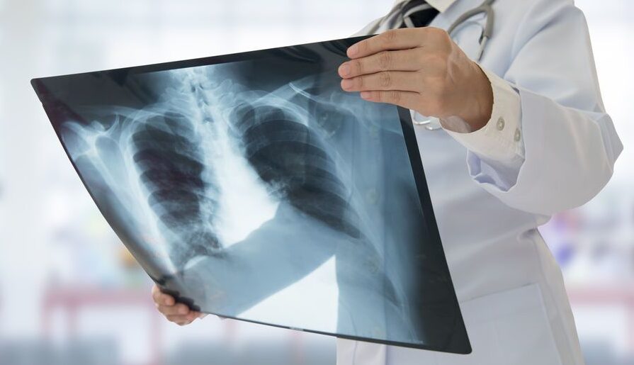 Pneumonia